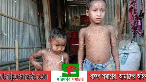 বিরল ইচথিয়োসিস রোগ থেকে বাঁচতে চায় আব্দুল্লাহ ও আমিনা রিস্কা চালক বাবার মানবিক সাহায্যের আবেদন